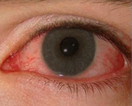 強い紫外線を浴びると、紫外線角膜炎という病気になる。