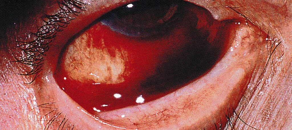 結膜下の出血