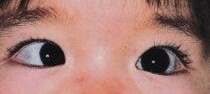 子供の斜視