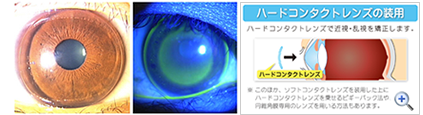 円錐角膜研究会画像