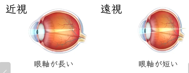 遠視と近視の眼軸