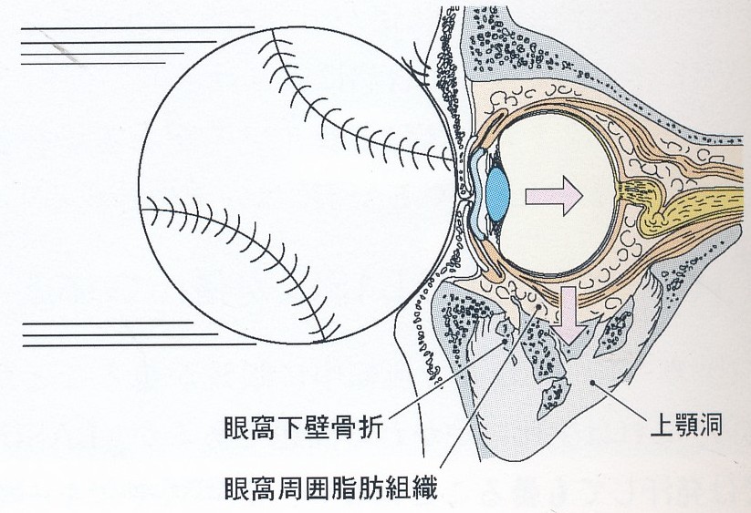 野球ボールが目にあたる
