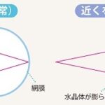 公益財団法人日本眼科学会より引用